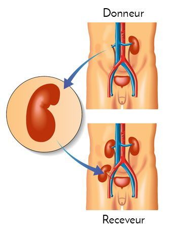 Transplantation renale