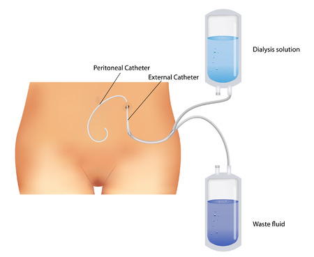 peritoneale dialyse procedure.